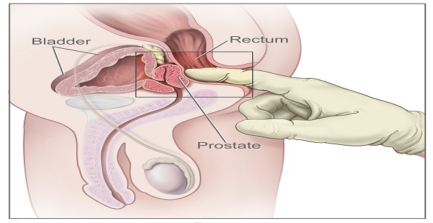 CDR457840 digital rectal exam